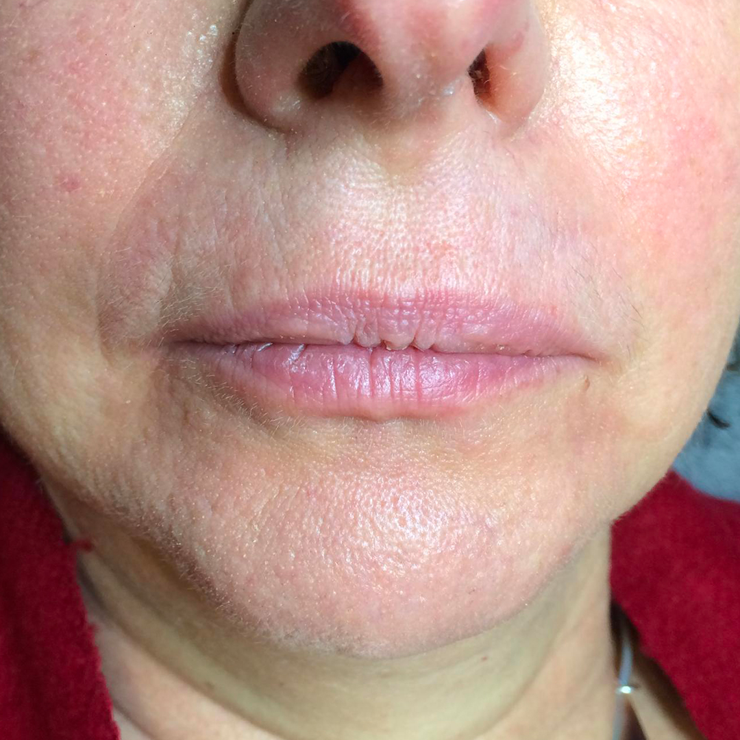 pigmentation contour degrade levres